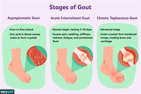 how long does gout last in foot.